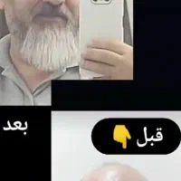 کاشت مو فول تراکم