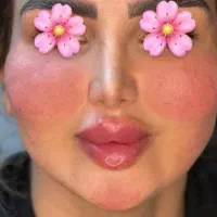 آف ژل و‌بوتاکس