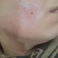 برداشتن انواع خال گوشتی و زگیل ومیکرونیدلینگ|خدمات آرایشگری و زیبایی|قم, انصار‌الحسین|دیوار