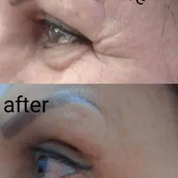 تخفیف بوتاکس و ژل|خدمات آرایشگری و زیبایی|دورود, |دیوار