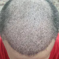 کاشت مو و کاشت ابرو وتزریق ژل و بوتاکس و مزو|خدمات آرایشگری و زیبایی|بهبهان, |دیوار