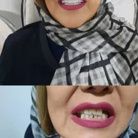 کامپوزیت متحرک دندان فوری|خدمات آرایشگری و زیبایی|مشهد, جانباز|دیوار