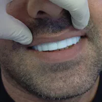 کامپوزیت دندان ((ویژه))|خدمات آرایشگری و زیبایی|یاسوج, |دیوار