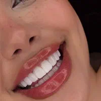دندانپزشکی زیبایی  ( جشنواره ونیر کامپوزیت زیبایی)
