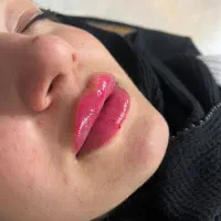 تزریق ژل و بوتاکس