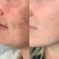 مدل رایگان برای رفع لک پوست با کرم ضدلک + مزو صورت|خدمات آرایشگری و زیبایی|شیراز, جوادیه|دیوار