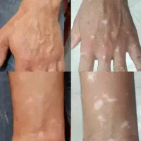 با رژیم غذایی مخصوص با محصولات گیاهی درمان قطعی
