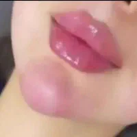 ژل بوتاکس مزو فیلر انزیم