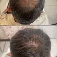 با پک اکسونیک از شر ریزش مو  خلاص شید