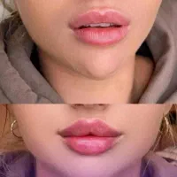 بلفاروپلاستی ۴۵۰۰/غبغب۴۵۰۰/کاشت ابرو|خدمات آرایشگری و زیبایی|ری, دیلمان|دیوار