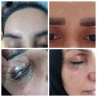 لیزر. پوست .حذف تاتو وبرداشت خال وپاکسازی پوست