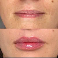 تزریق ژل .بوتاکس .انزیم بینی .مزوژل جوانساز|خدمات آرایشگری و زیبایی|جهرم, |دیوار