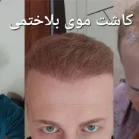 کاشت مو به صورت حرفه ای و با کیفیت عالی و تضمینی|خدمات آرایشگری و زیبایی|پارس‌آباد, |دیوار