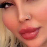 ژل  لب گونه چانه  زاویه بوتاکس فیلر