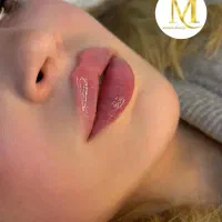 ژل و بوتاکس با تخفیف ۵۰ درصدی توسط پزشک