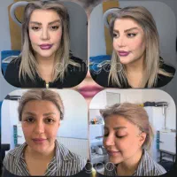 عمل لیفت چشم. ابرو.شقیقه.گونه.بوکال