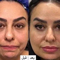 جراحی و زیبایی صورت و بدن، مزو، بوتاکس، چربی، فیلر|خدمات آرایشگری و زیبایی|کرمانشاه, |دیوار