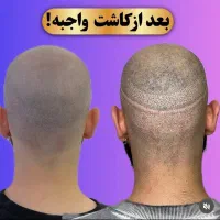 شبیه سازی فولیکول مو smp اس کالپ|خدمات آرایشگری و زیبایی|دوگنبدان, |دیوار