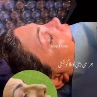 عمل بینی رینوپلاستی فقط 31 میلیون|خدمات آرایشگری و زیبایی|قم, جمکران|دیوار