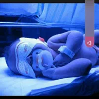 دستگاه زردی نوزادان