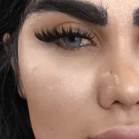 کاشت مژه کایلی