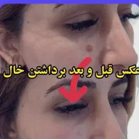 برداشتن خال و زیگیل در یک جلسه