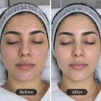 آموزش لاین پوست باتخفیف ویژه .