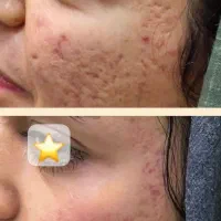 کرم بیوممتیک ترمیم کننده اسکار (قول جایگذین لیزر)