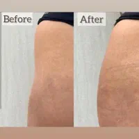 دوره تخصصی فیلر بادی(باسن/هیپ دیپ/بیکینی ساق پا)|خدمات آرایشگری و زیبایی|شاهین‌شهر, فردوسی|دیوار