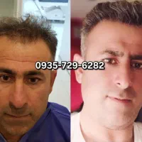 کاشت مو فقط ۲۰ میلیون
