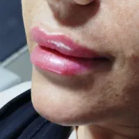مدل برای عکاسی فیلر بوتاکس مزو میکرو نیدلینگ
