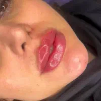 مدل فیلر بوتاکس برداشتن خال زگیل لیزر فیلرزیر چشم