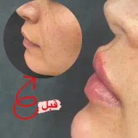 بوتاکس۸۷۰ ژل لب ۹۸۰فیلر ۸۹۰پی ارپی مزو۸۹۰