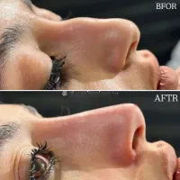 تزریق ژل و بوتاکس تضمینی|خدمات آرایشگری و زیبایی|قرچک, مهدیه|دیوار