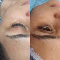 هایفوتراپی لیزر پاکسازی پلاژن روشن سازی فیشیال|خدمات آرایشگری و زیبایی|شیراز, ریاستی|دیوار