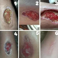 درمان انواع زخم ها با روش های بروز  پزشکی