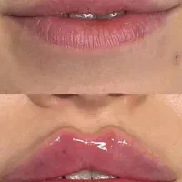 ژل لب و صورت/فیلر بادی/بوتاکس/مزوژل ۳۰٪ تخفیف