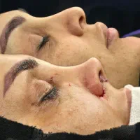 جراحی زیبایی بینی با قیمت مناسب و روش مدرن