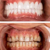 شرایط ویژه کامپوزیت دندان|خدمات آرایشگری و زیبایی|آذرشهر, |دیوار