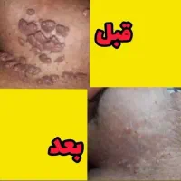 درمان ریشه ای زگیل و تبخال به صورت گیاهی|آرایشی، بهداشتی، درمانی|ساری, |دیوار