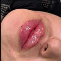 تخفیف ژل ،بوتاکس ،جوانساز،فیلر،ساکشن|خدمات آرایشگری و زیبایی|کرج, گلشهر|دیوار