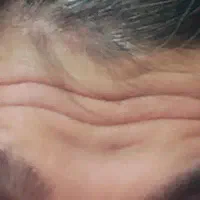بوتاکس صورت و بوتاکس زیر بغل با تخفیف ویژه