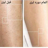 لیزر موهای زائد با جوابدهی تضمینی|خدمات آرایشگری و زیبایی|فولادشهر, B5|دیوار