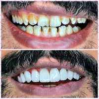 کامپوزیت دندان درمحل شمامنزل یامحل کار|خدمات آرایشگری و زیبایی|هشتگرد, شهرک گلخانه|دیوار