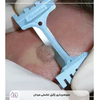 بهبود تبخال و زگیل تناسلی بدون عوارض در منزل