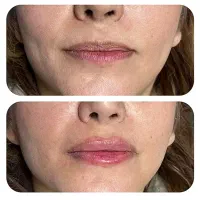 تزریق ژل و بوتاکس|خدمات آرایشگری و زیبایی|امیدیه, |دیوار