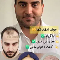 کاشت تخصصی مو ،ابرو ،ریش