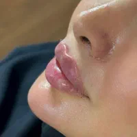 تزریق ژل و بوتاکس، لیزر ،هایفو اندولیفت فیلر بادی|خدمات آرایشگری و زیبایی|کرج, مهرویلا جنوبی|دیوار