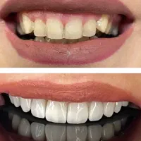 دندانپزشکی (ایمپلنت .لمینت .کامپوزیت )اقساطی