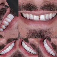دندانپزشکی،کامپوزیت دندان،روکش دندان|خدمات آرایشگری و زیبایی|شیراز, شهرک ولیعصر|دیوار